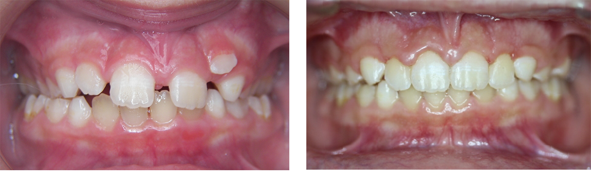 Invisalign in Greenwich