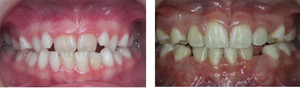 Pediatric Orthodontics in Greenwich