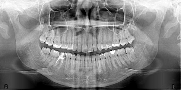 Invisalign in Greenwich